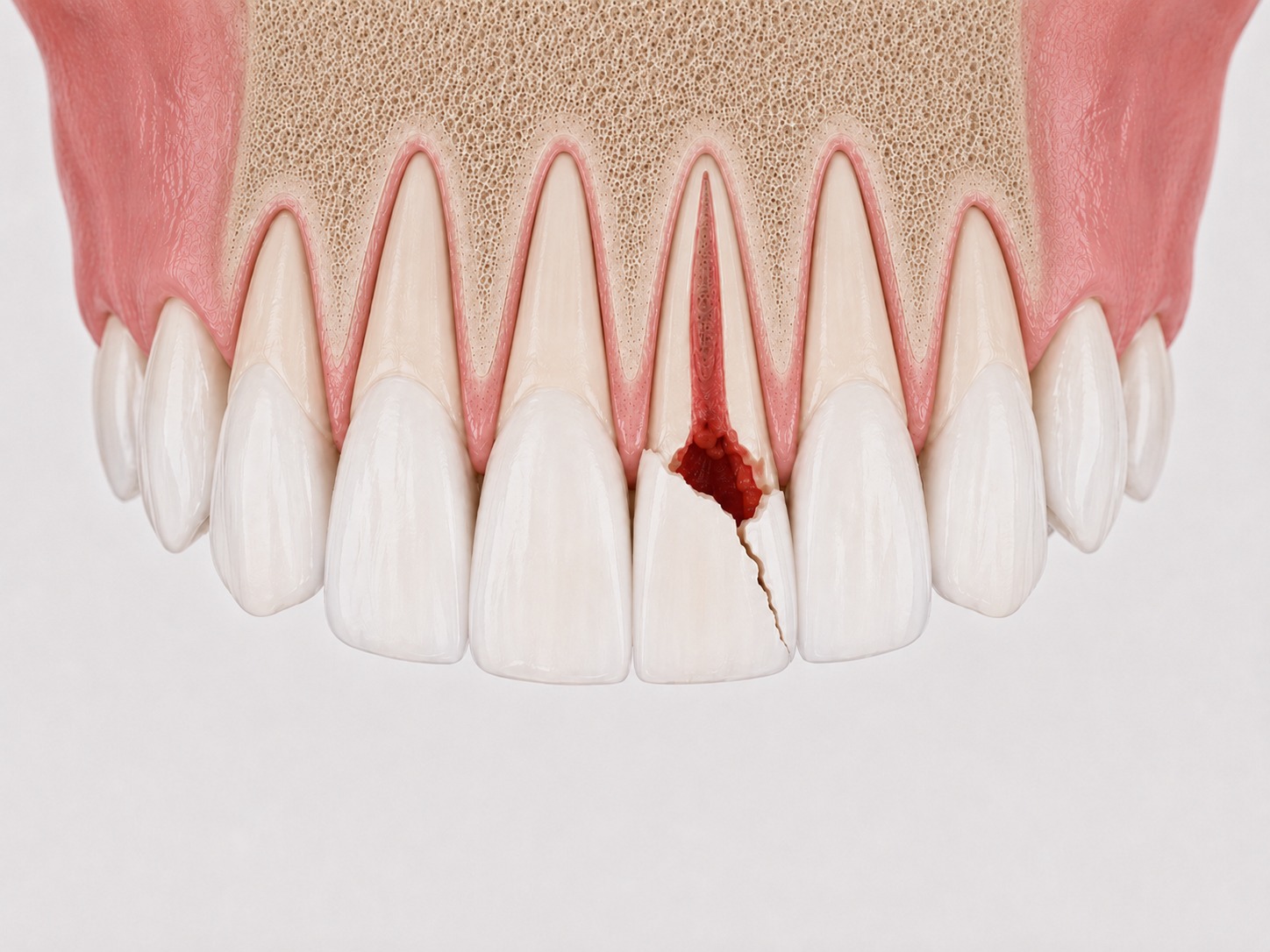 Zahntrauma — Frakturversorgung und Reimplantation