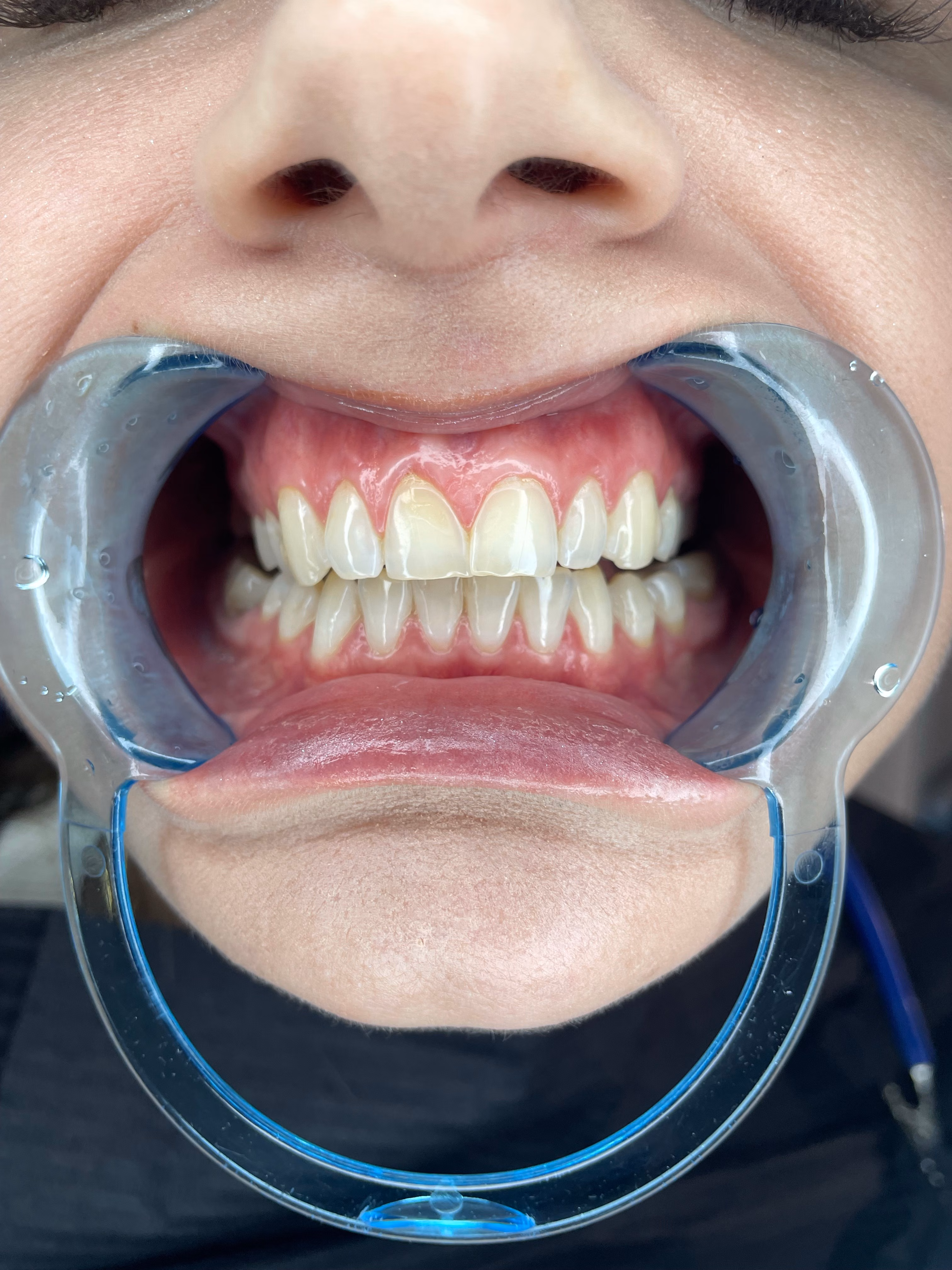 In-Office Bleaching