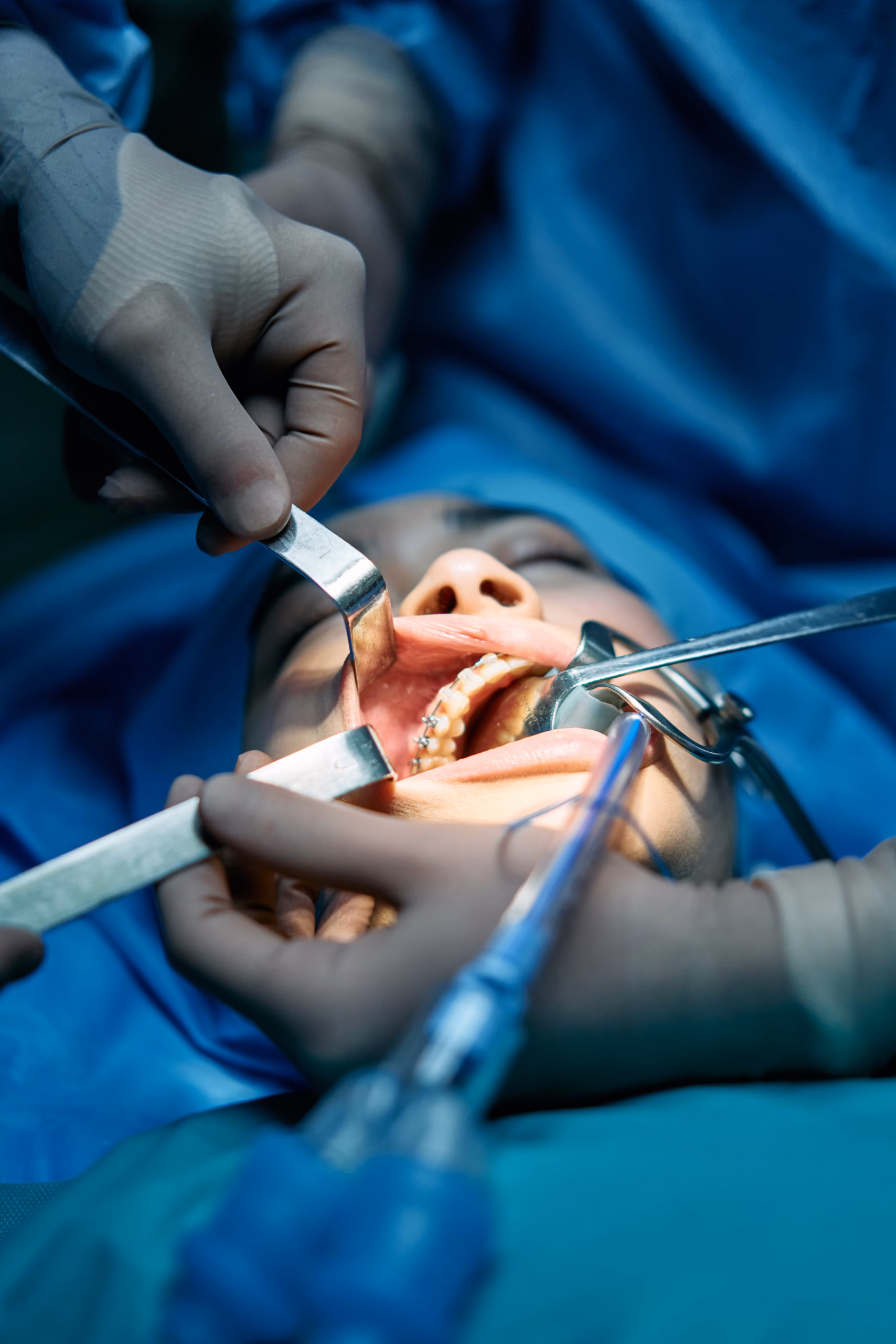 Lappenoperation