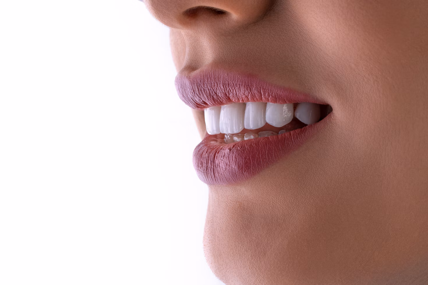 Non-Prep-Veneers
